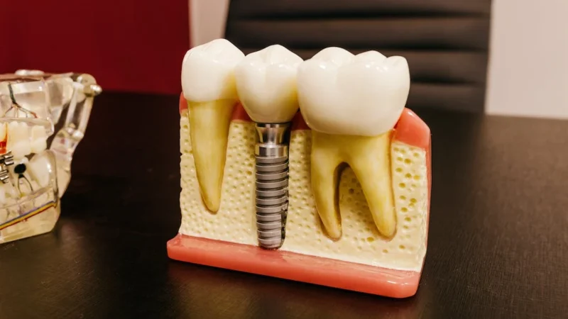 Veja qual é valor de um implante dentário em 2023