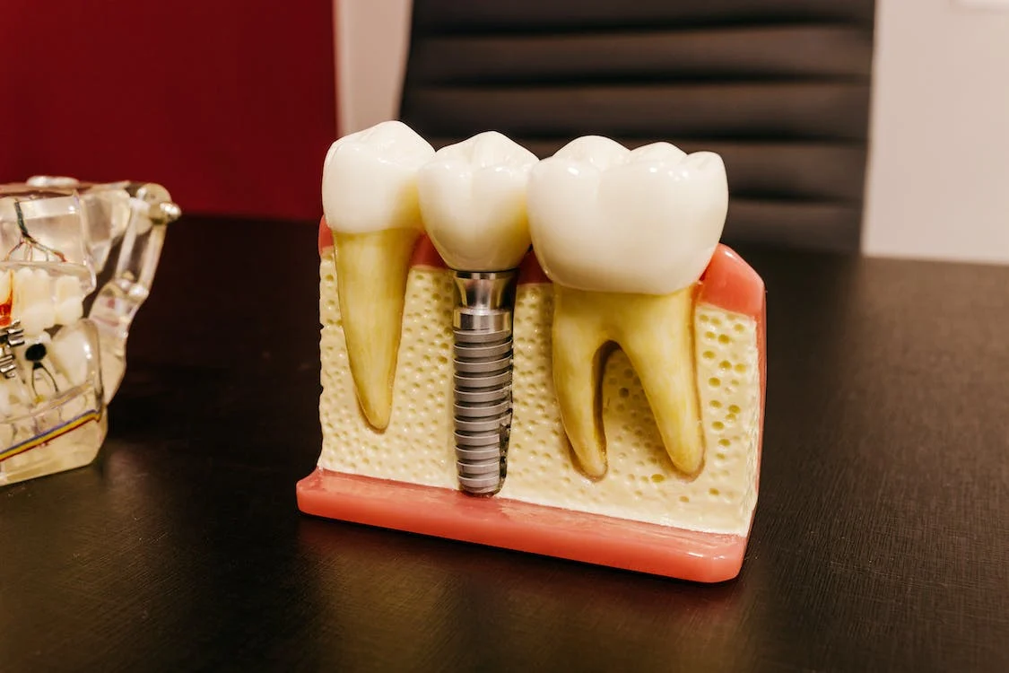 Veja qual é valor de um implante dentário em 2023